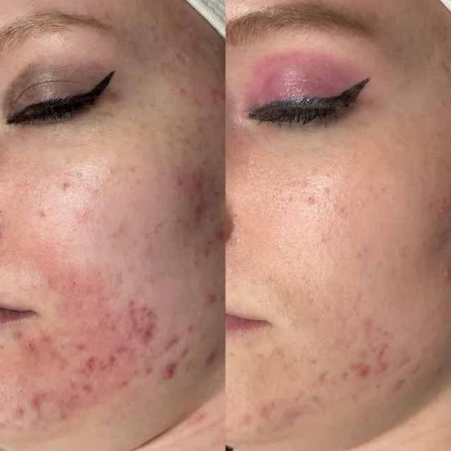 Microneedling+Website-640w